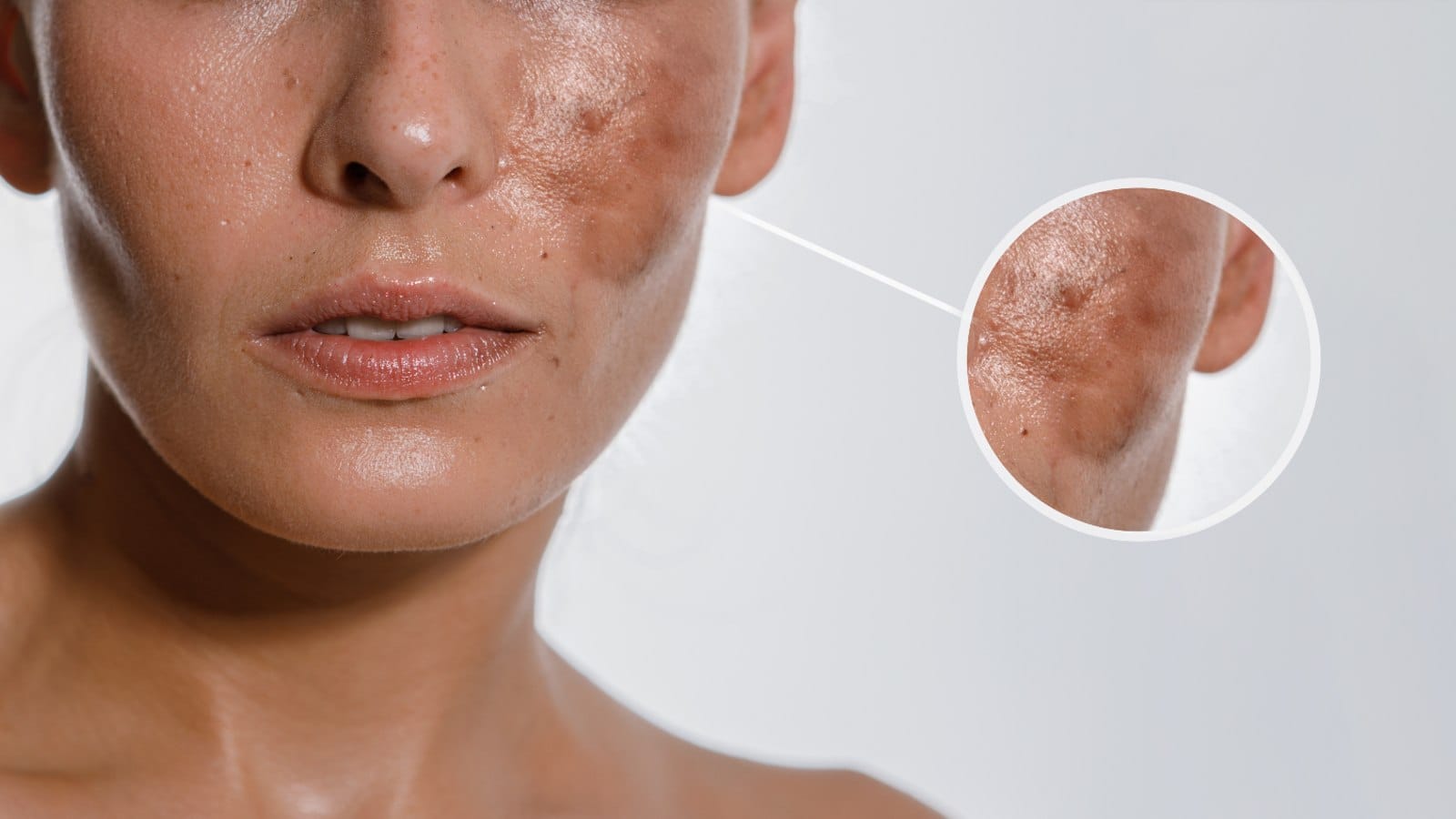 hyperpigmentation